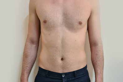 after electromagnetic system treatment for body shaping